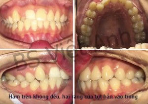 DRVA2
